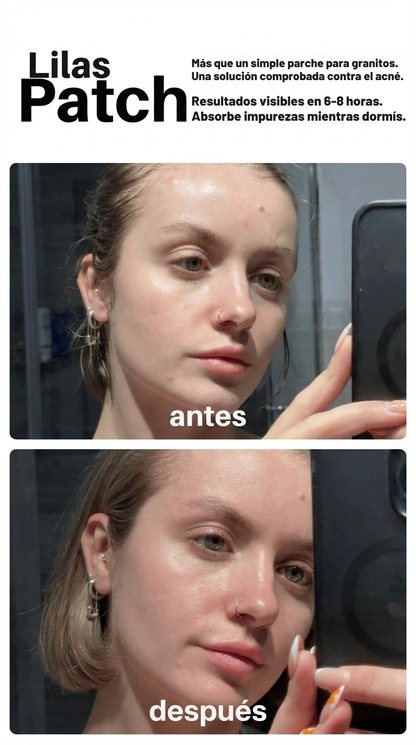 Lilas Patch |La solución rápida contra los granitos.
